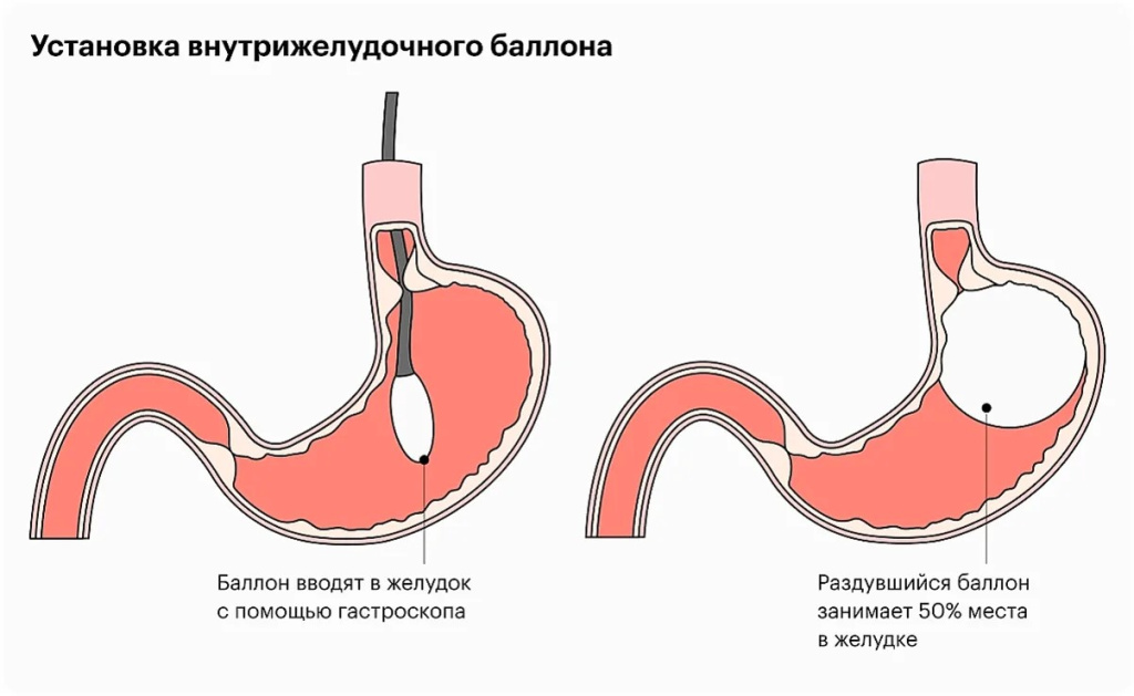 Баллонная пластика позволяет уменьшить объем желудка Установка внутрижелудочного баллона